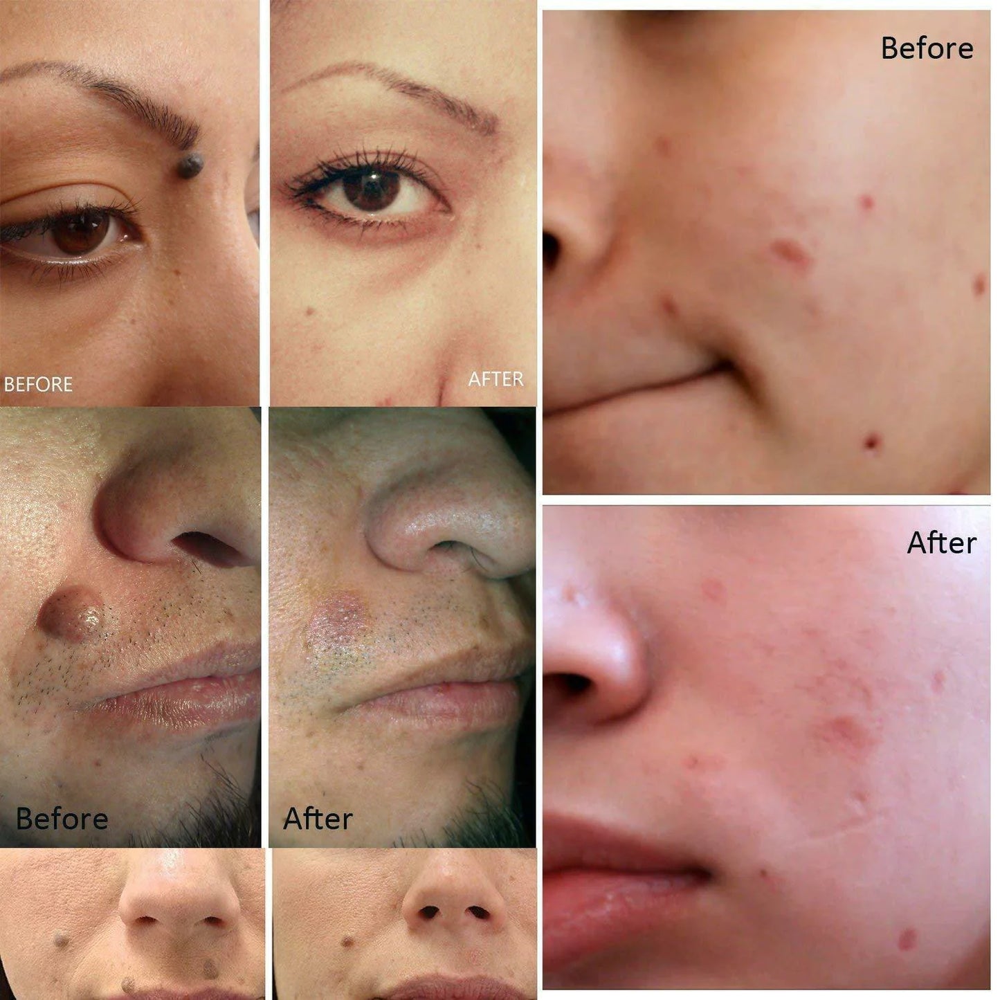 Professional Mole & Skin Tag Remover